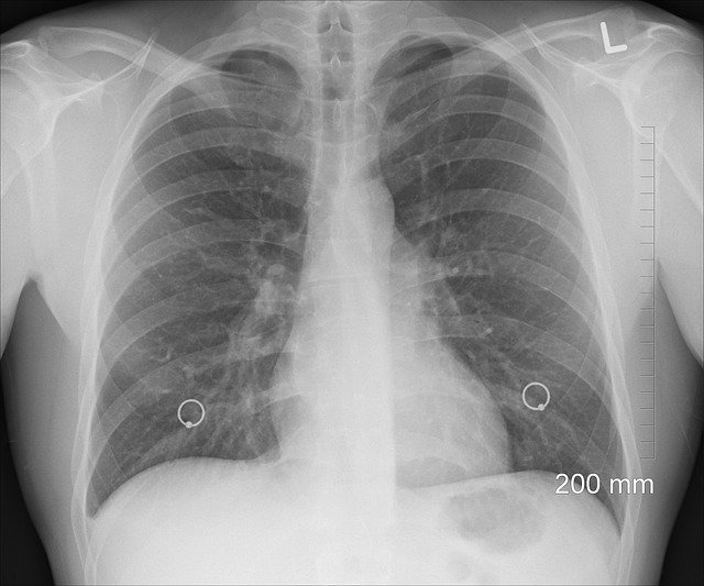 Co powoduje zapalenie płuc?